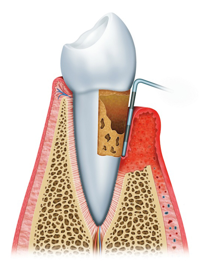 Stages of Gum Disease Yuma, AZ