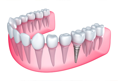 Single Missing Tooth in Yuma, AZ