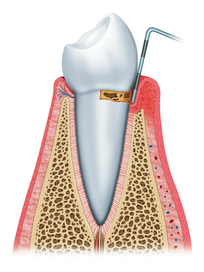 Stages of Gum Disease Yuma, AZ