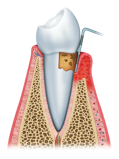 Stages of Gum Disease Yuma, AZ