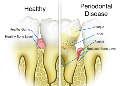 Gum Disease and Tooth and Bone Loss Yuma, AZ